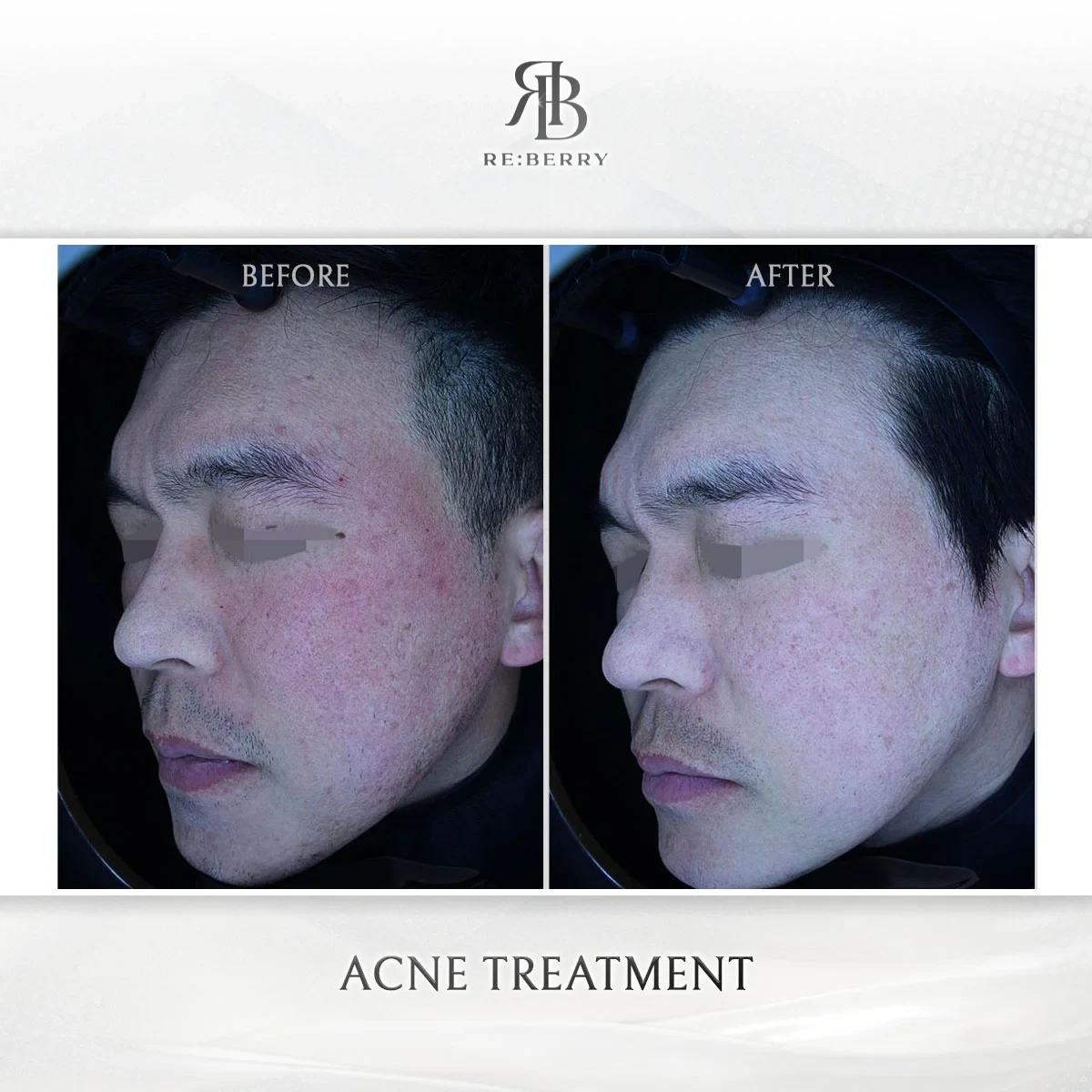 Before and after skin & laser treatment result at RE:BERRY Gangnam Aesthetic Clinic Seoul — real patient photo