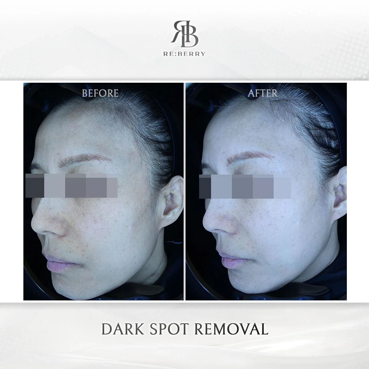 Before and after skin & laser treatment result at RE:BERRY Gangnam Aesthetic Clinic Seoul — real patient photo
