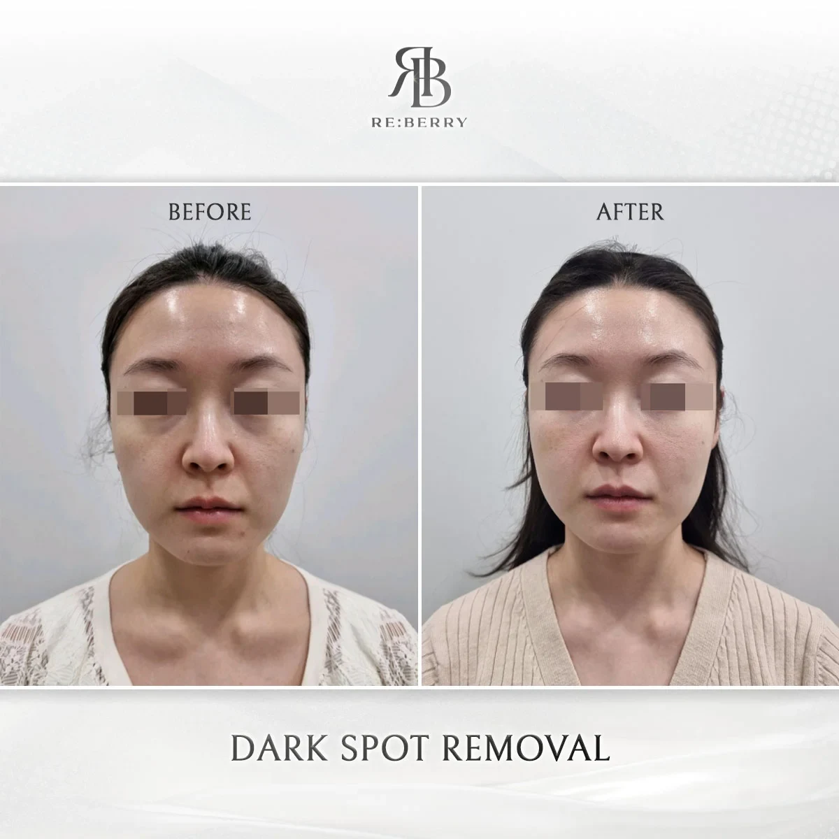 Before and after skin & laser treatment result at RE:BERRY Gangnam Aesthetic Clinic Seoul — real patient photo