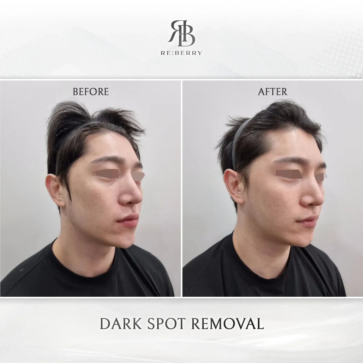 Before and after skin & laser treatment result at RE:BERRY Gangnam Aesthetic Clinic Seoul — real patient photo