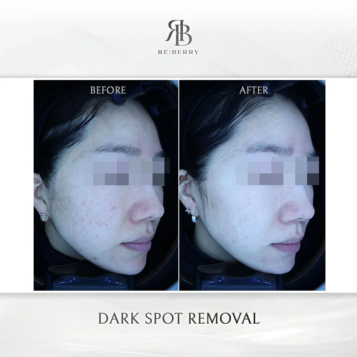 Before and after skin & laser treatment result at RE:BERRY Gangnam Aesthetic Clinic Seoul — real patient photo