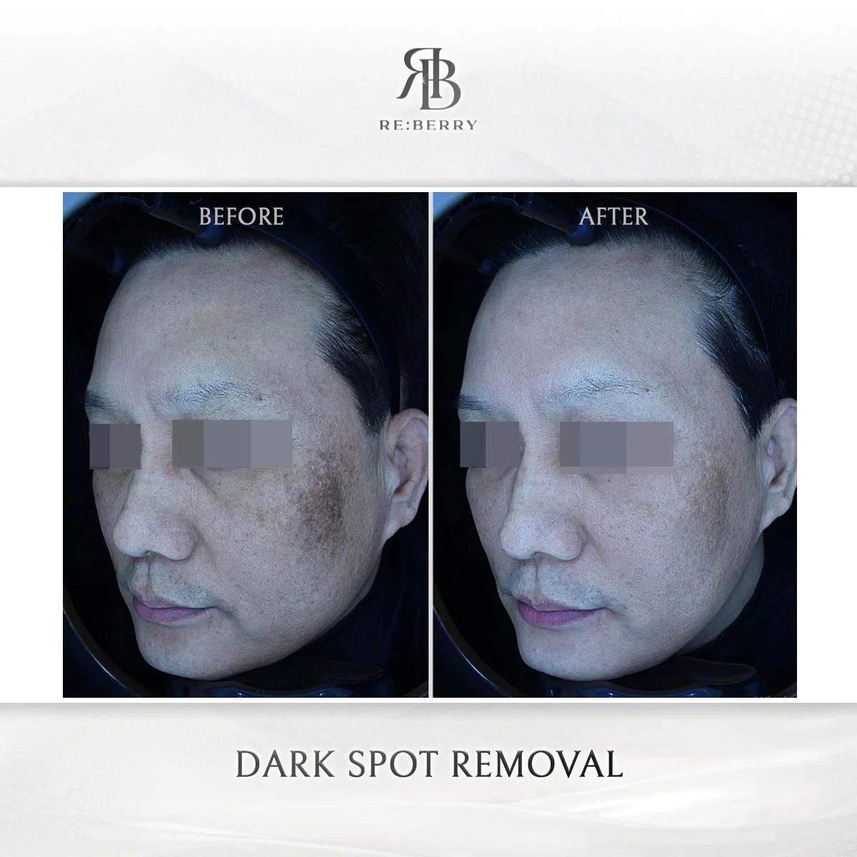 Before and after skin & laser treatment result at RE:BERRY Gangnam Aesthetic Clinic Seoul — real patient photo
