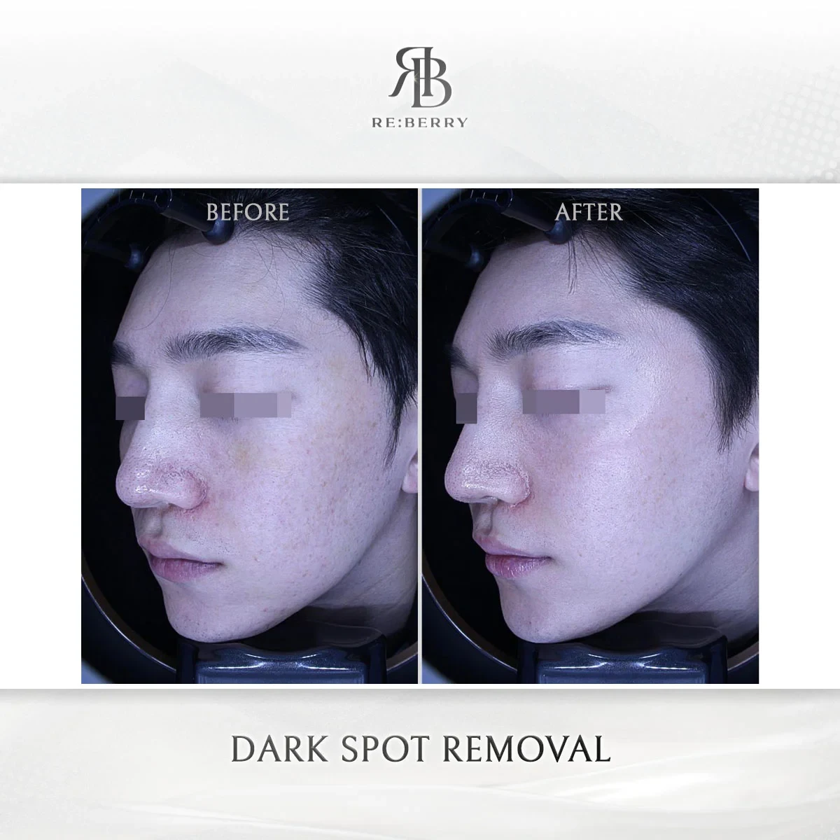 Before and after skin & laser treatment result at RE:BERRY Gangnam Aesthetic Clinic Seoul — real patient photo
