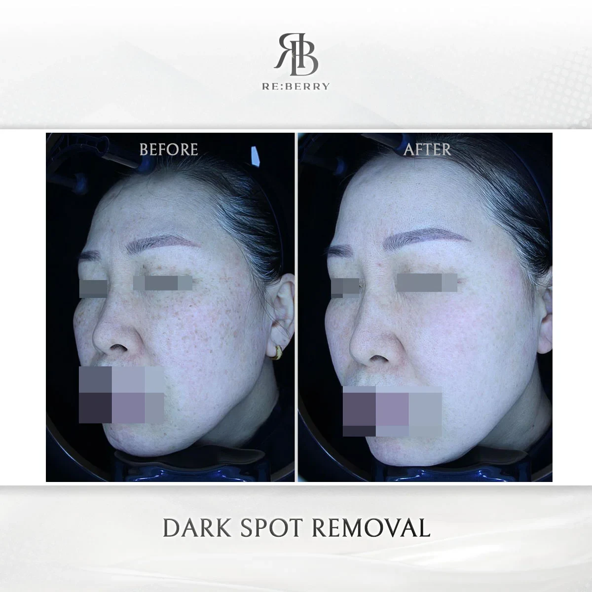 Before and after skin & laser treatment result at RE:BERRY Gangnam Aesthetic Clinic Seoul — real patient photo