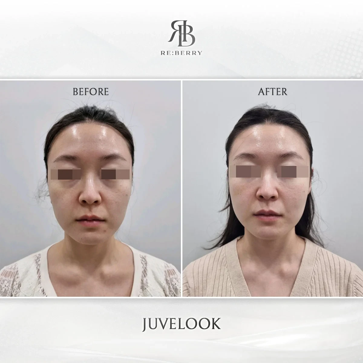 Before and after skin & laser treatment result at RE:BERRY Gangnam Aesthetic Clinic Seoul — real patient photo