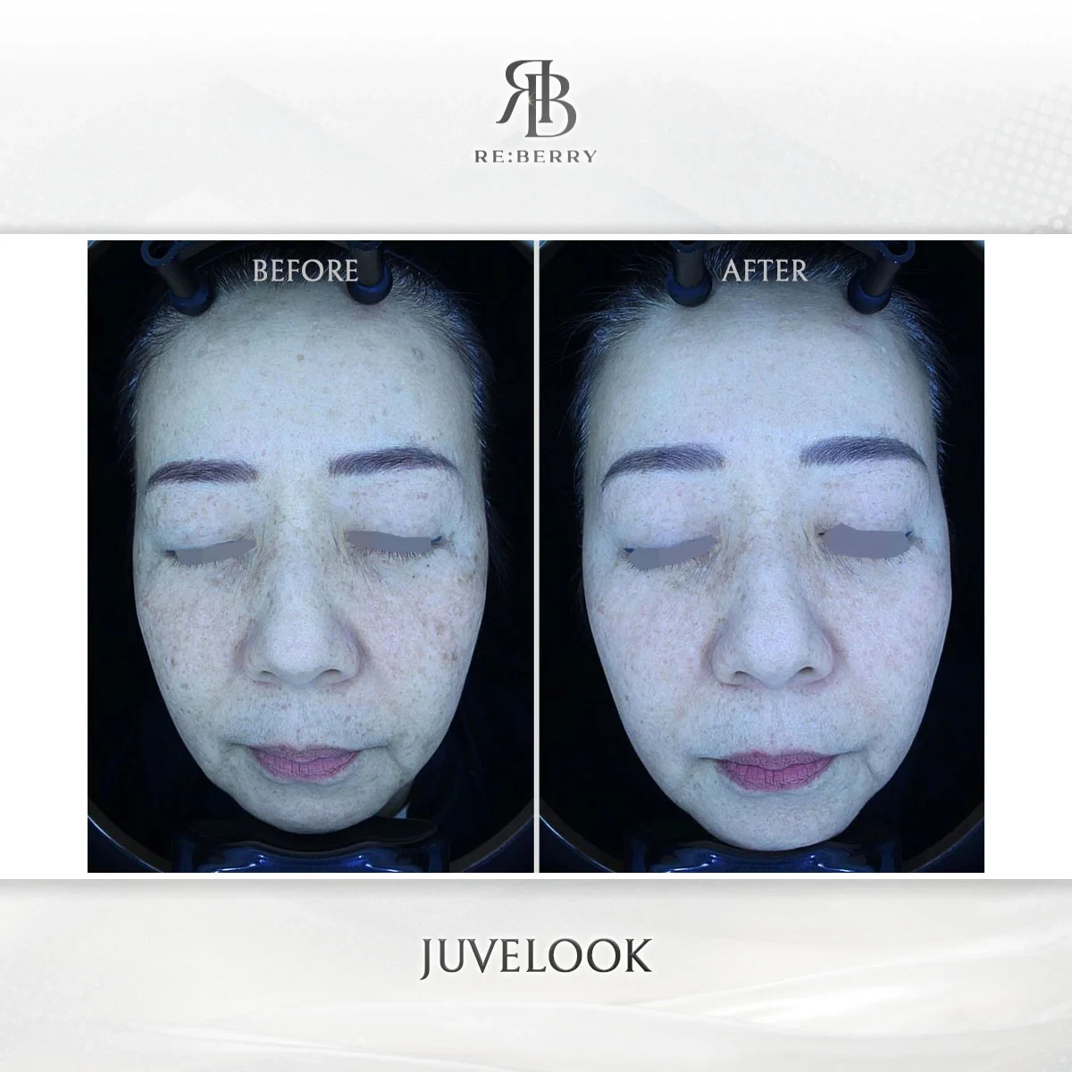 Before and after skin & laser treatment result at RE:BERRY Gangnam Aesthetic Clinic Seoul — real patient photo