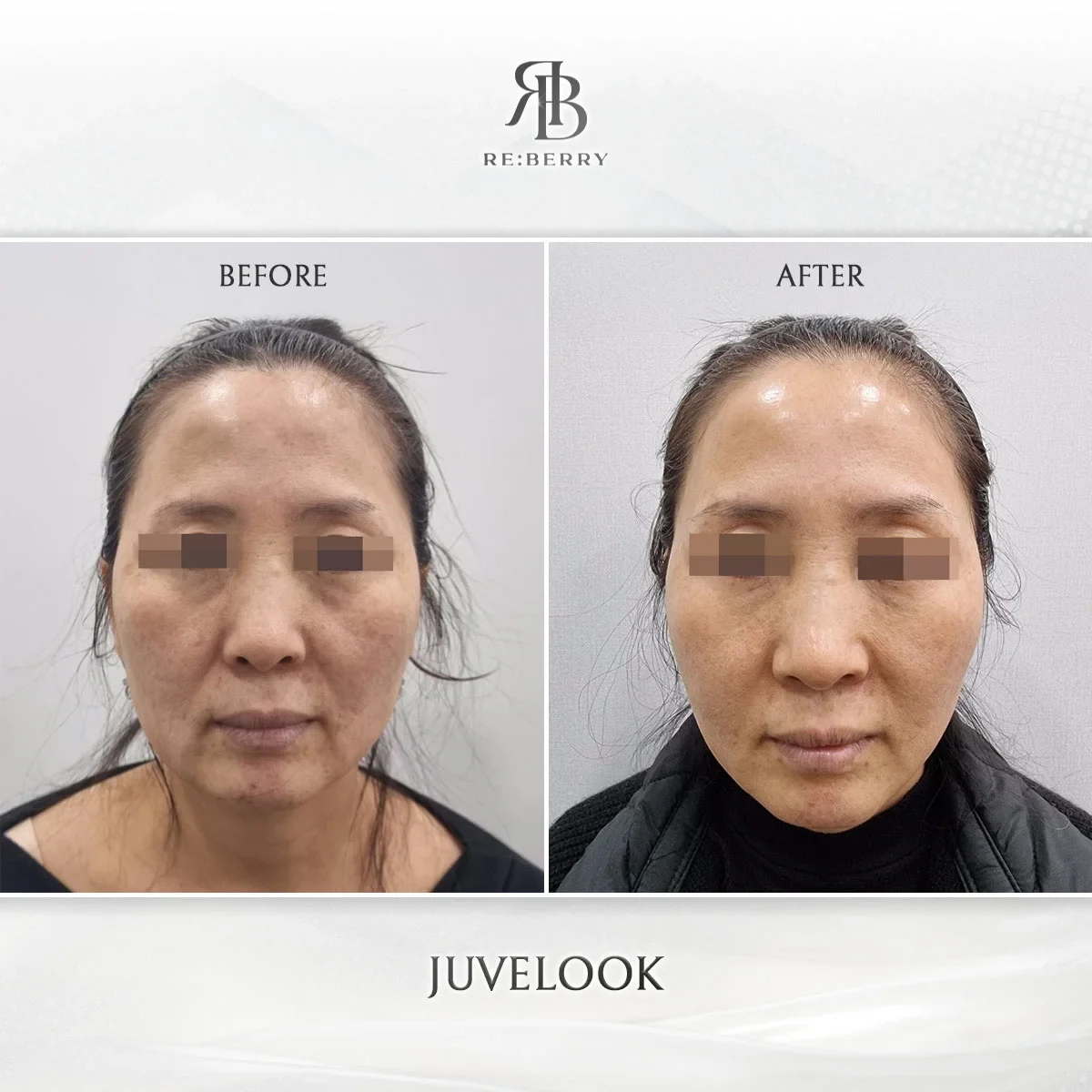 Before and after skin & laser treatment result at RE:BERRY Gangnam Aesthetic Clinic Seoul — real patient photo
