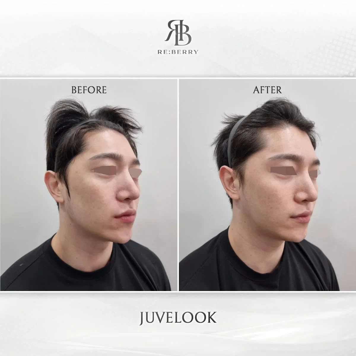 Before and after skin & laser treatment result at RE:BERRY Gangnam Aesthetic Clinic Seoul — real patient photo