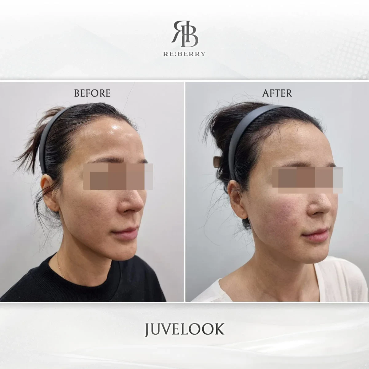 Before and after skin & laser treatment result at RE:BERRY Gangnam Aesthetic Clinic Seoul — real patient photo