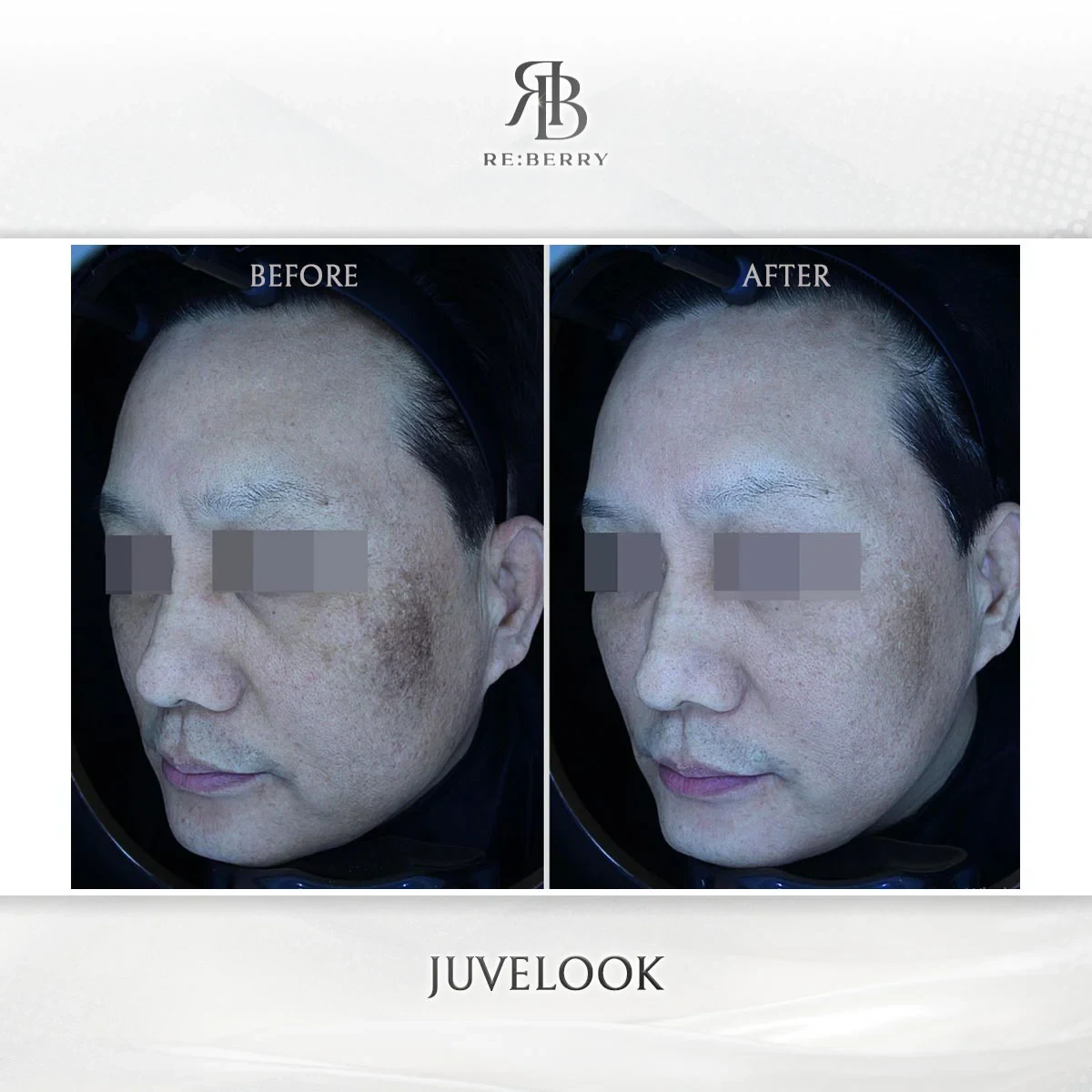 Before and after skin & laser treatment result at RE:BERRY Gangnam Aesthetic Clinic Seoul — real patient photo