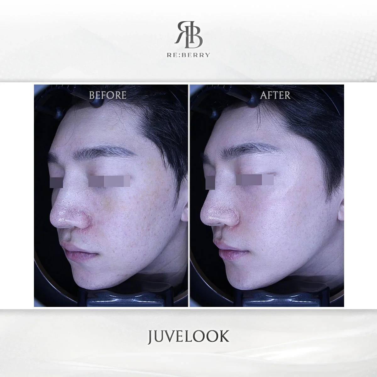 Before and after skin & laser treatment result at RE:BERRY Gangnam Aesthetic Clinic Seoul — real patient photo