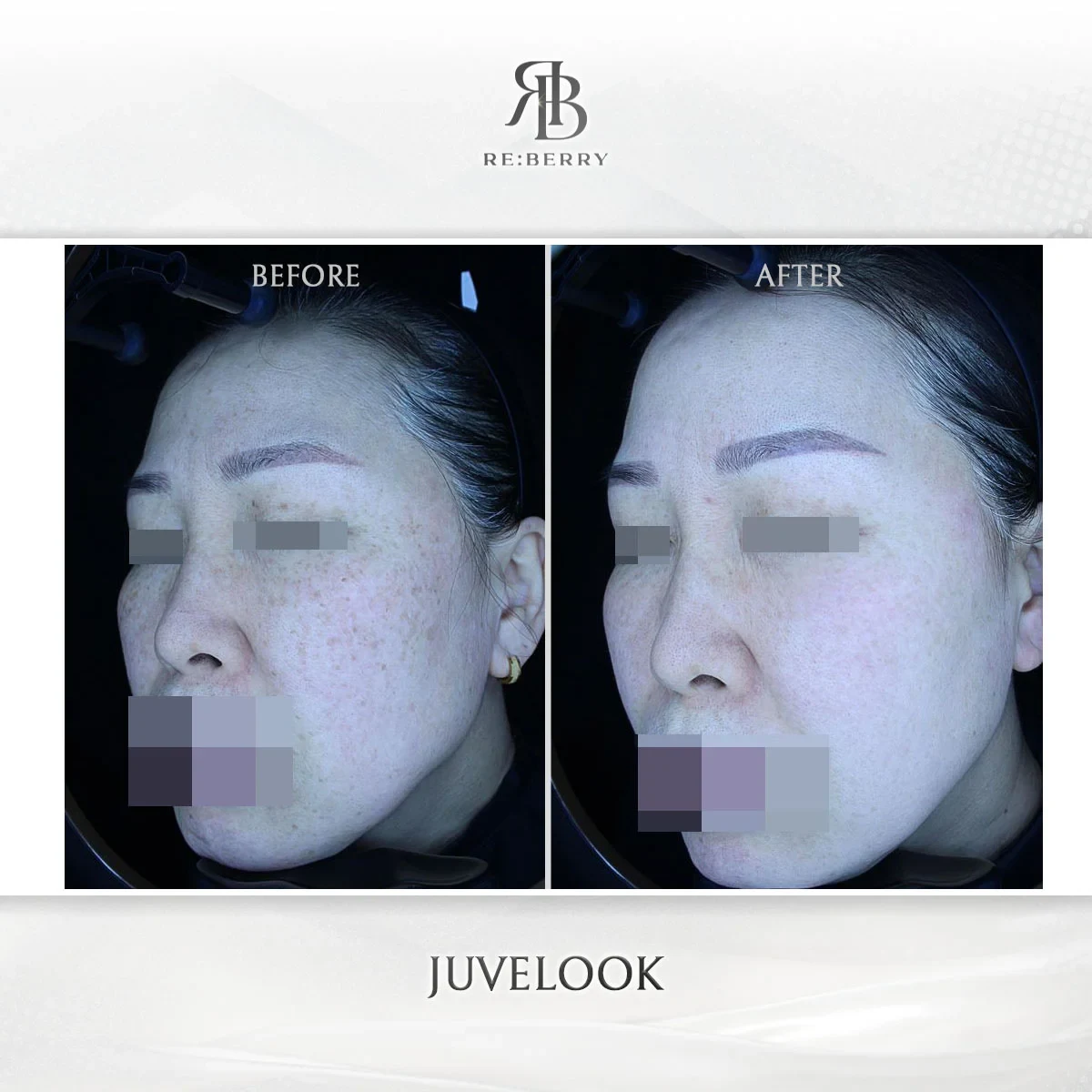 Before and after skin & laser treatment result at RE:BERRY Gangnam Aesthetic Clinic Seoul — real patient photo