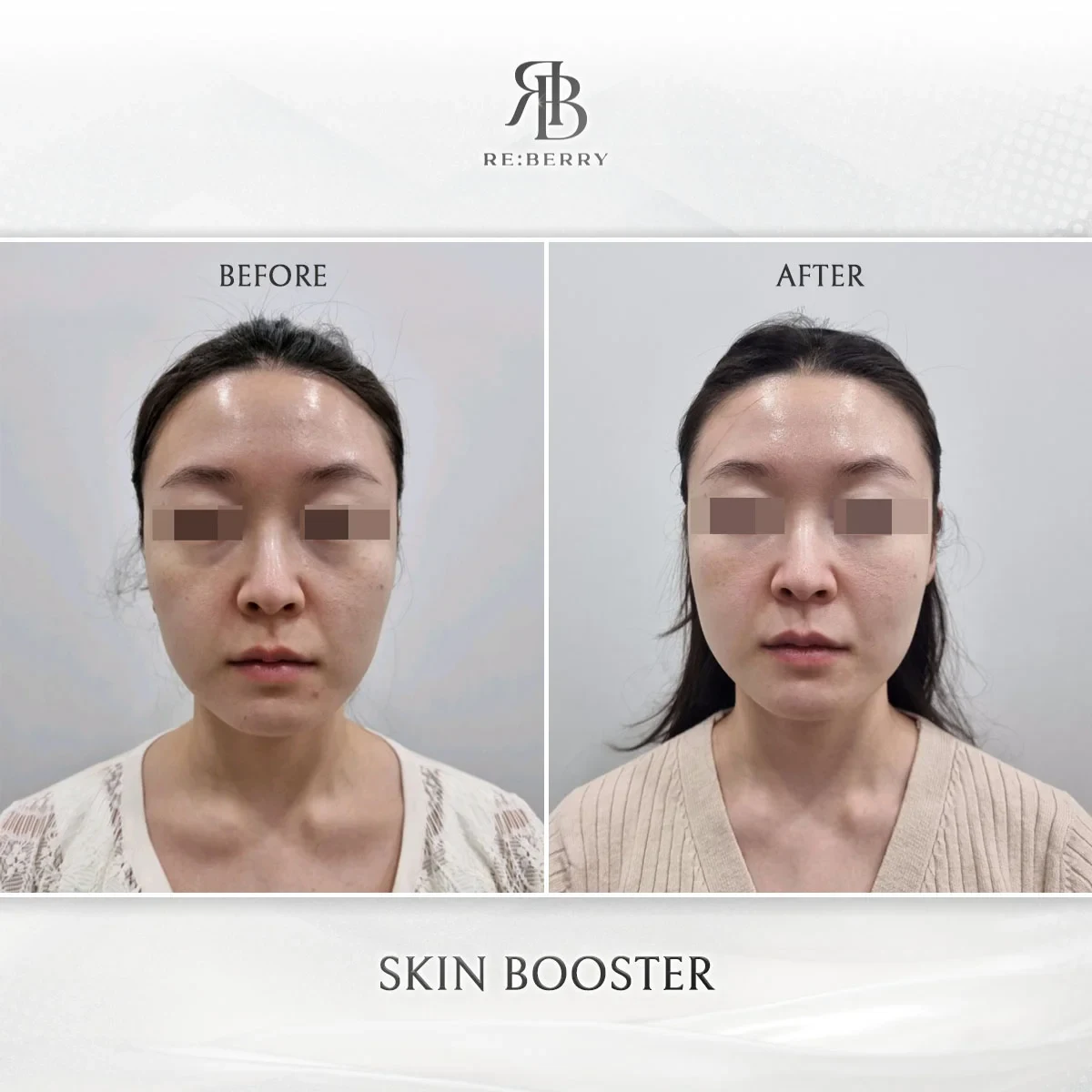Before and after skin & laser treatment result at RE:BERRY Gangnam Aesthetic Clinic Seoul — real patient photo