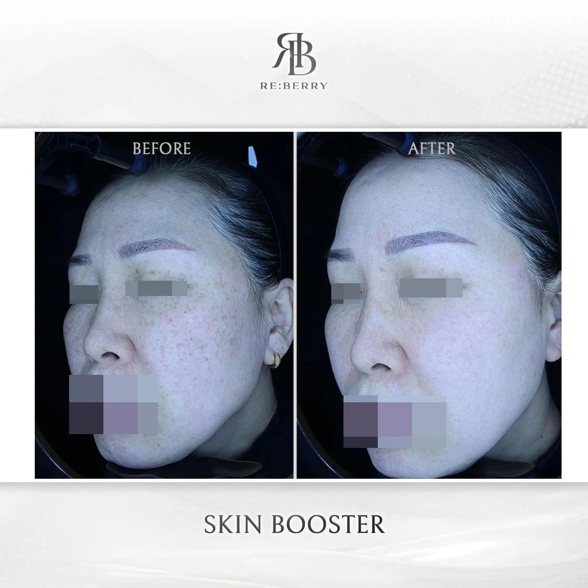 Before and after skin & laser treatment result at RE:BERRY Gangnam Aesthetic Clinic Seoul — real patient photo