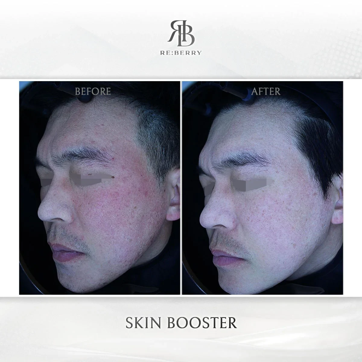 Before and after skin & laser treatment result at RE:BERRY Gangnam Aesthetic Clinic Seoul — real patient photo