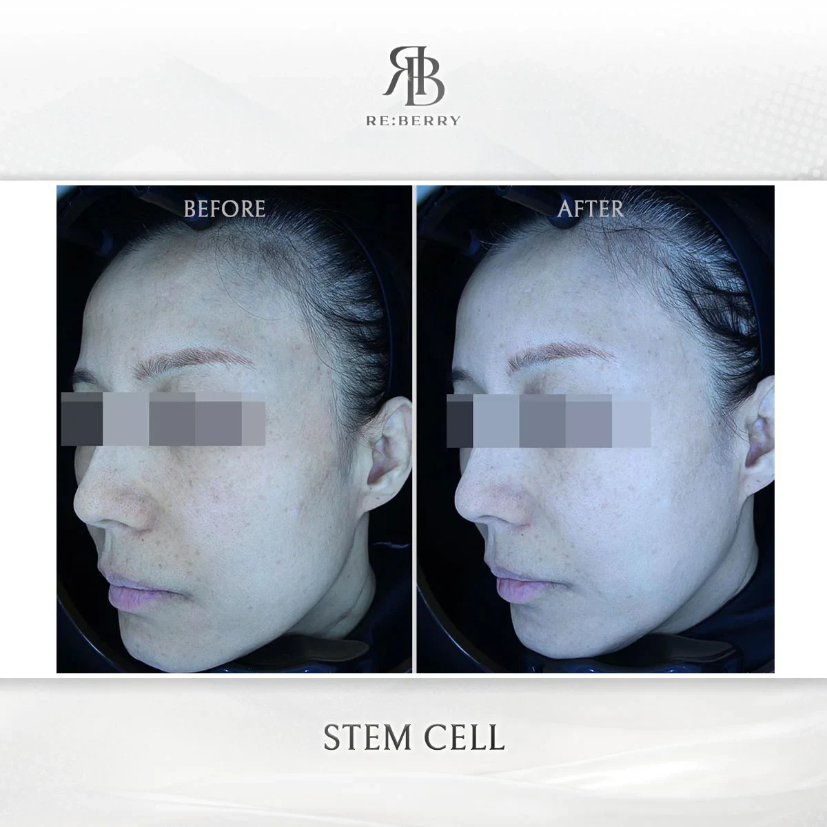 Before and after stem cell treatment result at RE:BERRY Gangnam Aesthetic Clinic Seoul — real patient photo
