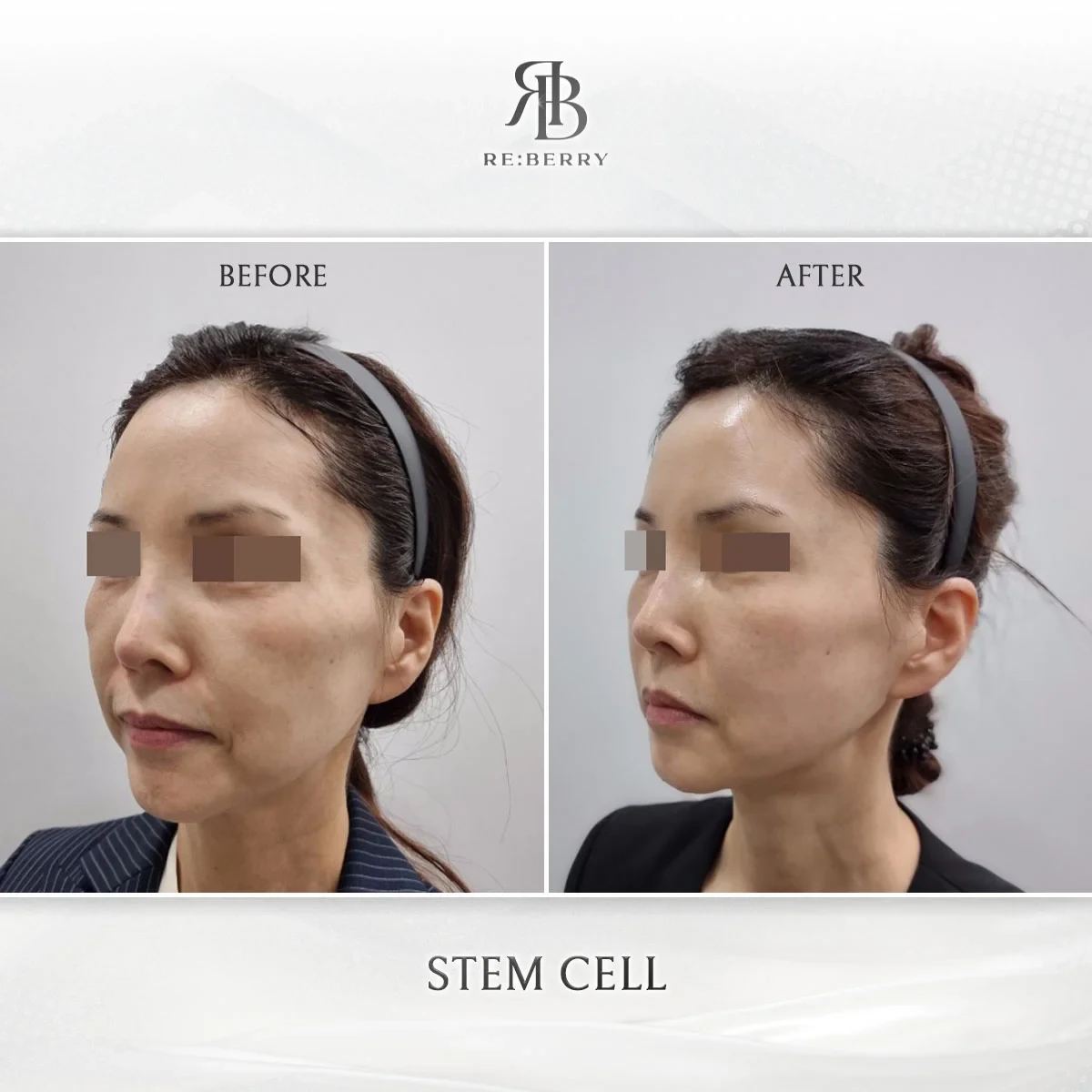 Before and after stem cell treatment result at RE:BERRY Gangnam Aesthetic Clinic Seoul — real patient photo