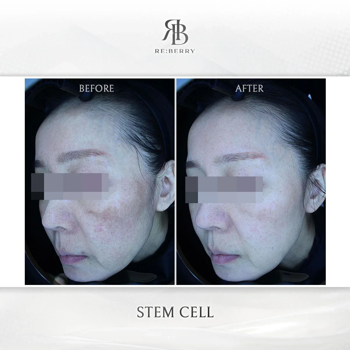 Before and after stem cell treatment result at RE:BERRY Gangnam Aesthetic Clinic Seoul — real patient photo