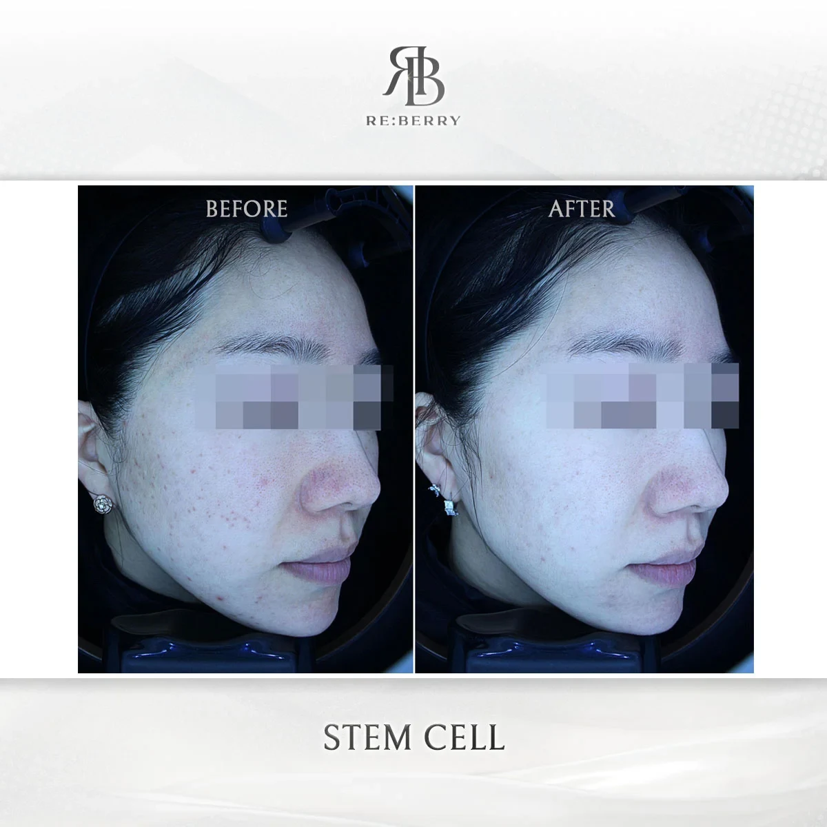 Before and after stem cell treatment result at RE:BERRY Gangnam Aesthetic Clinic Seoul — real patient photo