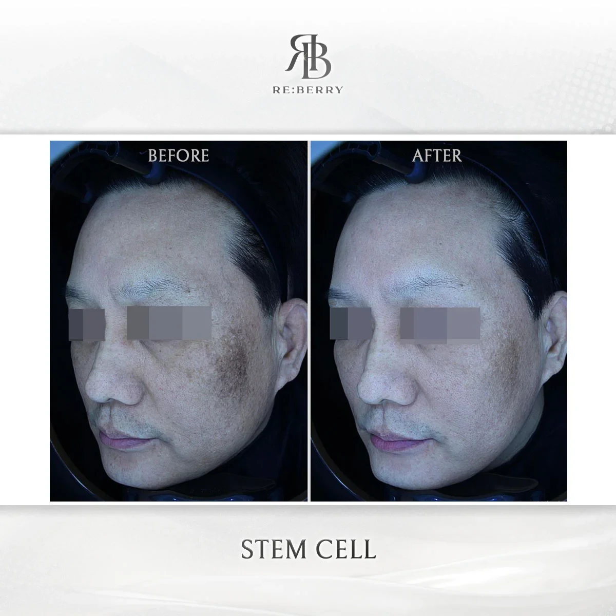 Before and after stem cell treatment result at RE:BERRY Gangnam Aesthetic Clinic Seoul — real patient photo