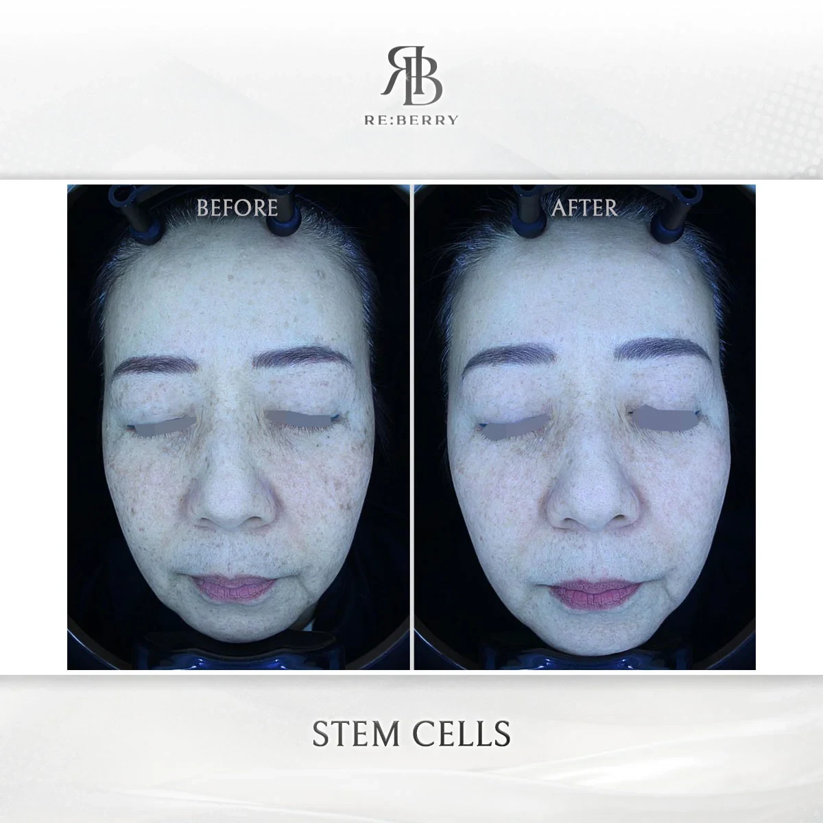 Before and after stem cell treatment result at RE:BERRY Gangnam Aesthetic Clinic Seoul — real patient photo