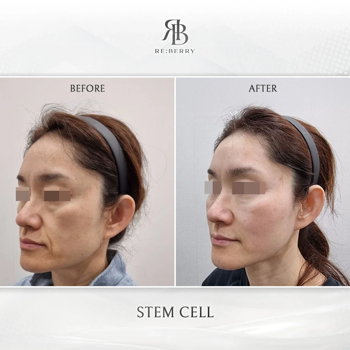 Before and after stem cell treatment result at RE:BERRY Gangnam Aesthetic Clinic Seoul — real patient photo