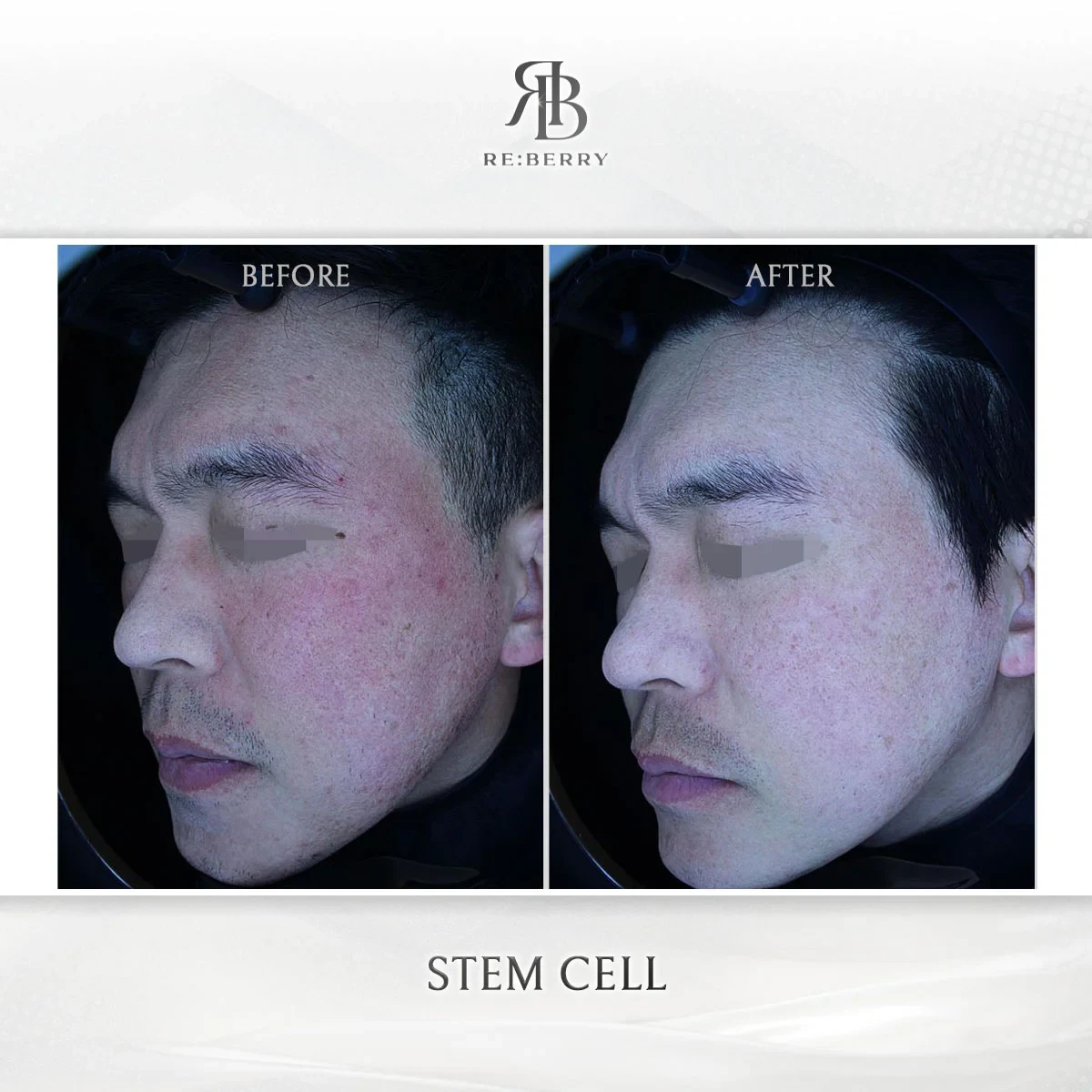 Before and after stem cell treatment result at RE:BERRY Gangnam Aesthetic Clinic Seoul — real patient photo
