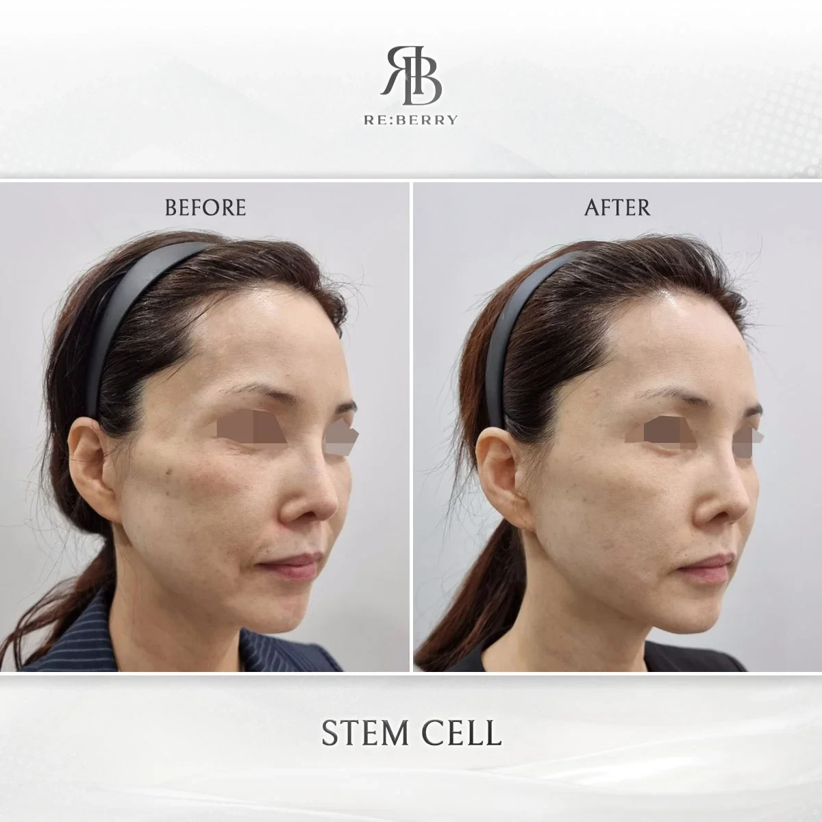 Before and after stem cell treatment result at RE:BERRY Gangnam Aesthetic Clinic Seoul — real patient photo