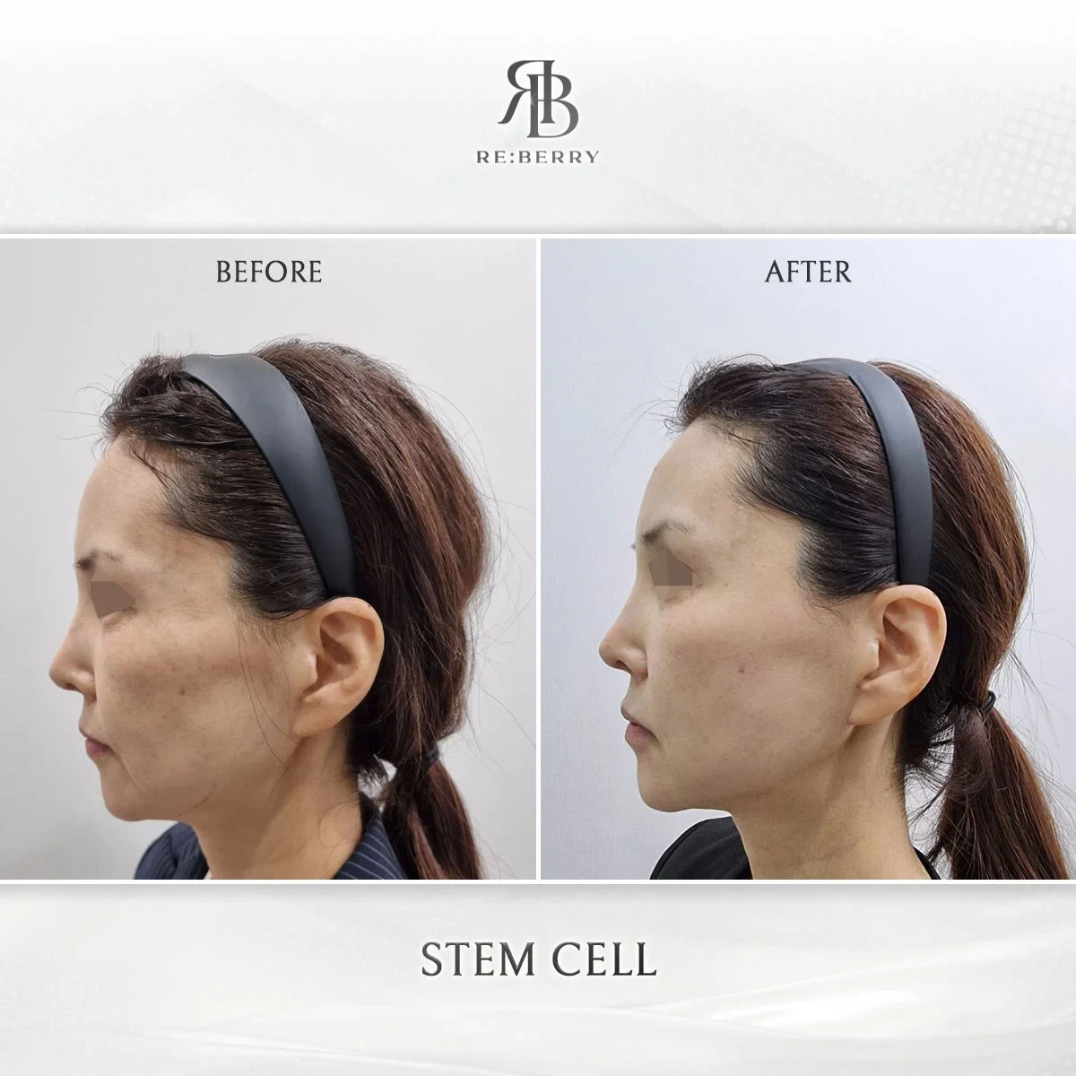Before and after stem cell treatment result at RE:BERRY Gangnam Aesthetic Clinic Seoul — real patient photo