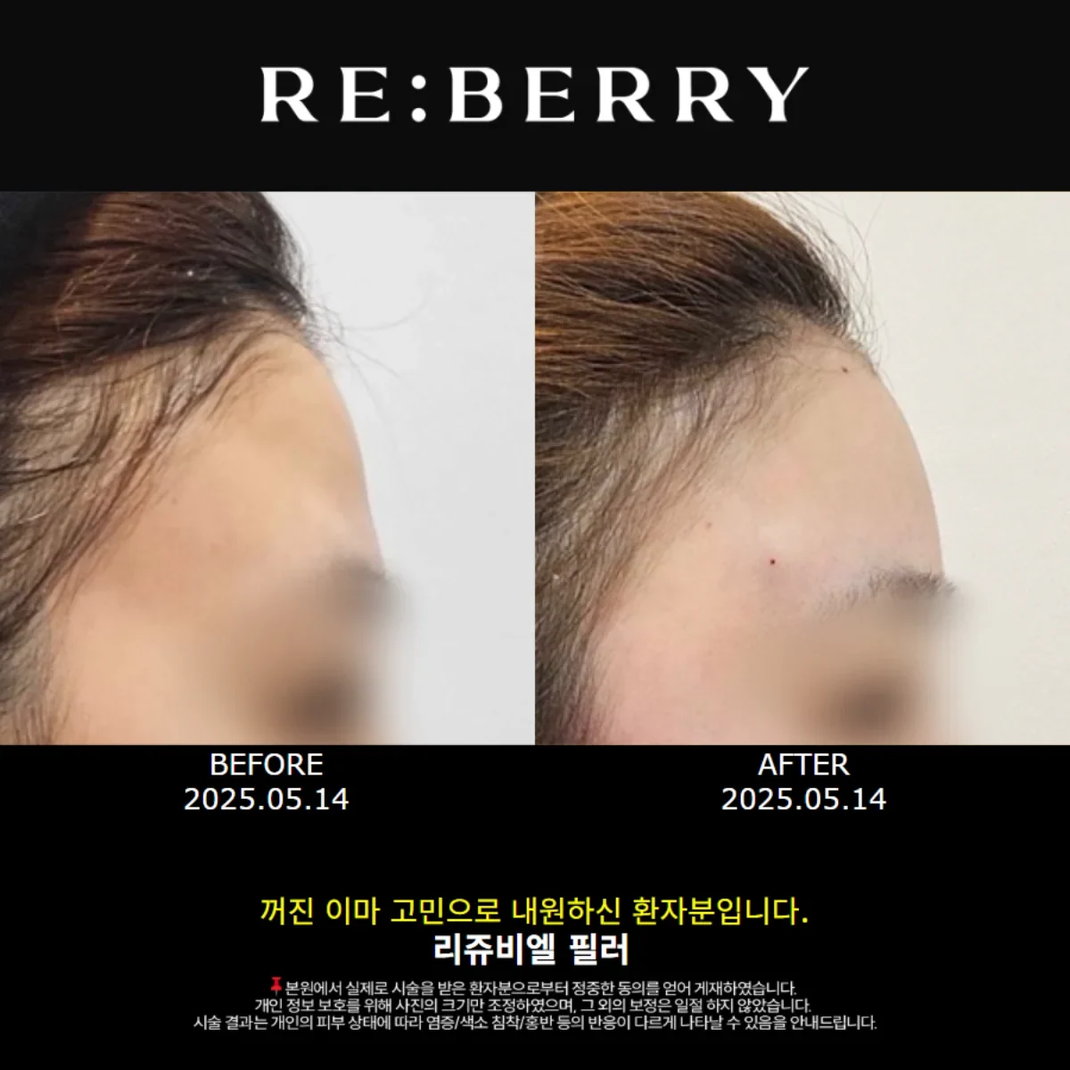 Before and after volume & filler treatment result at RE:BERRY Gangnam Aesthetic Clinic Seoul — real patient photo