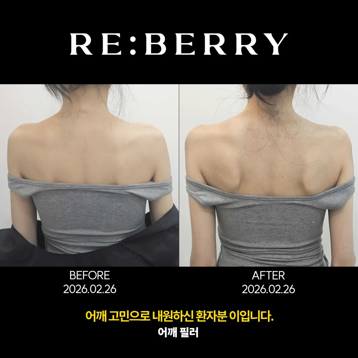 Before and after volume & filler treatment result at RE:BERRY Gangnam Aesthetic Clinic Seoul — real patient photo