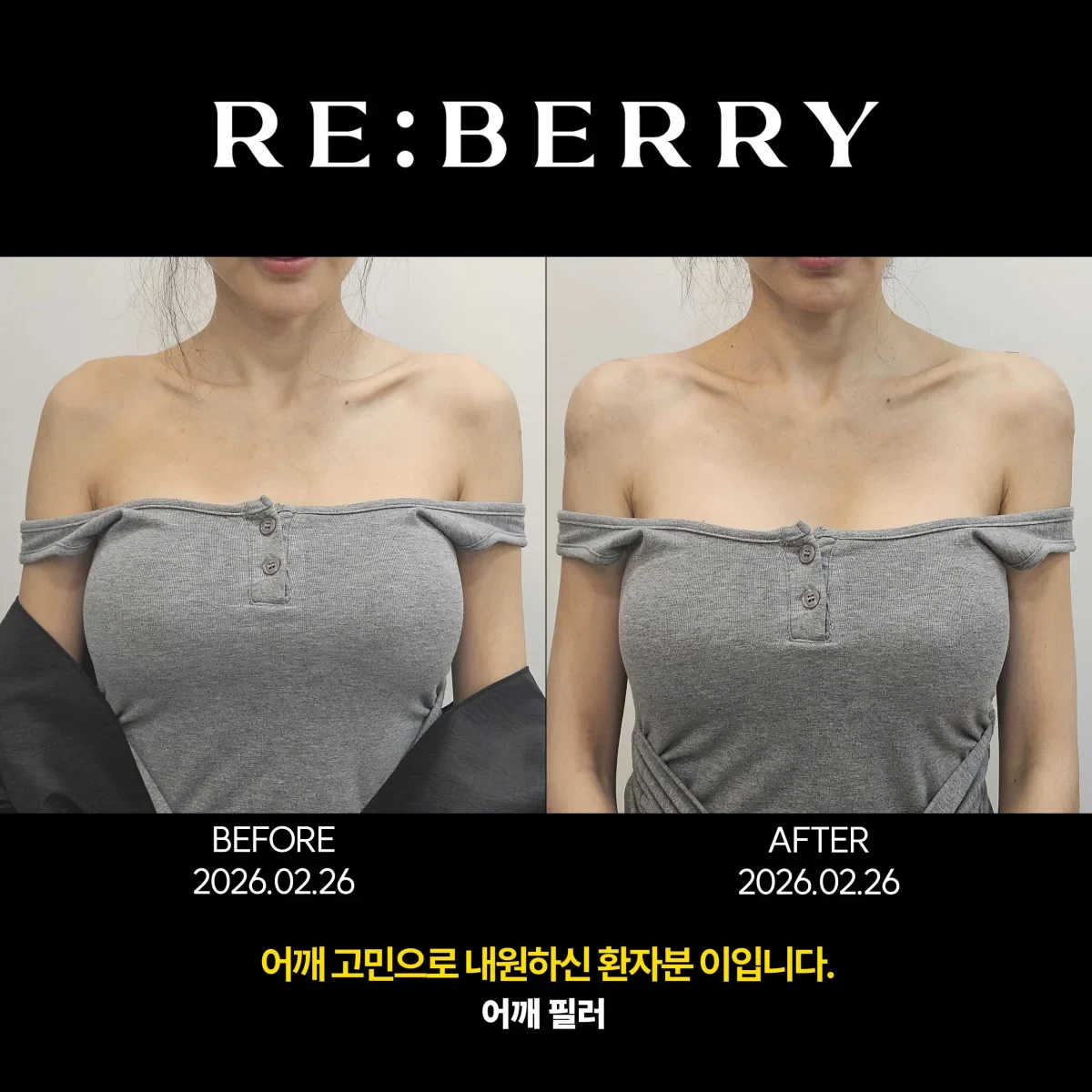Before and after volume & filler treatment result at RE:BERRY Gangnam Aesthetic Clinic Seoul — real patient photo