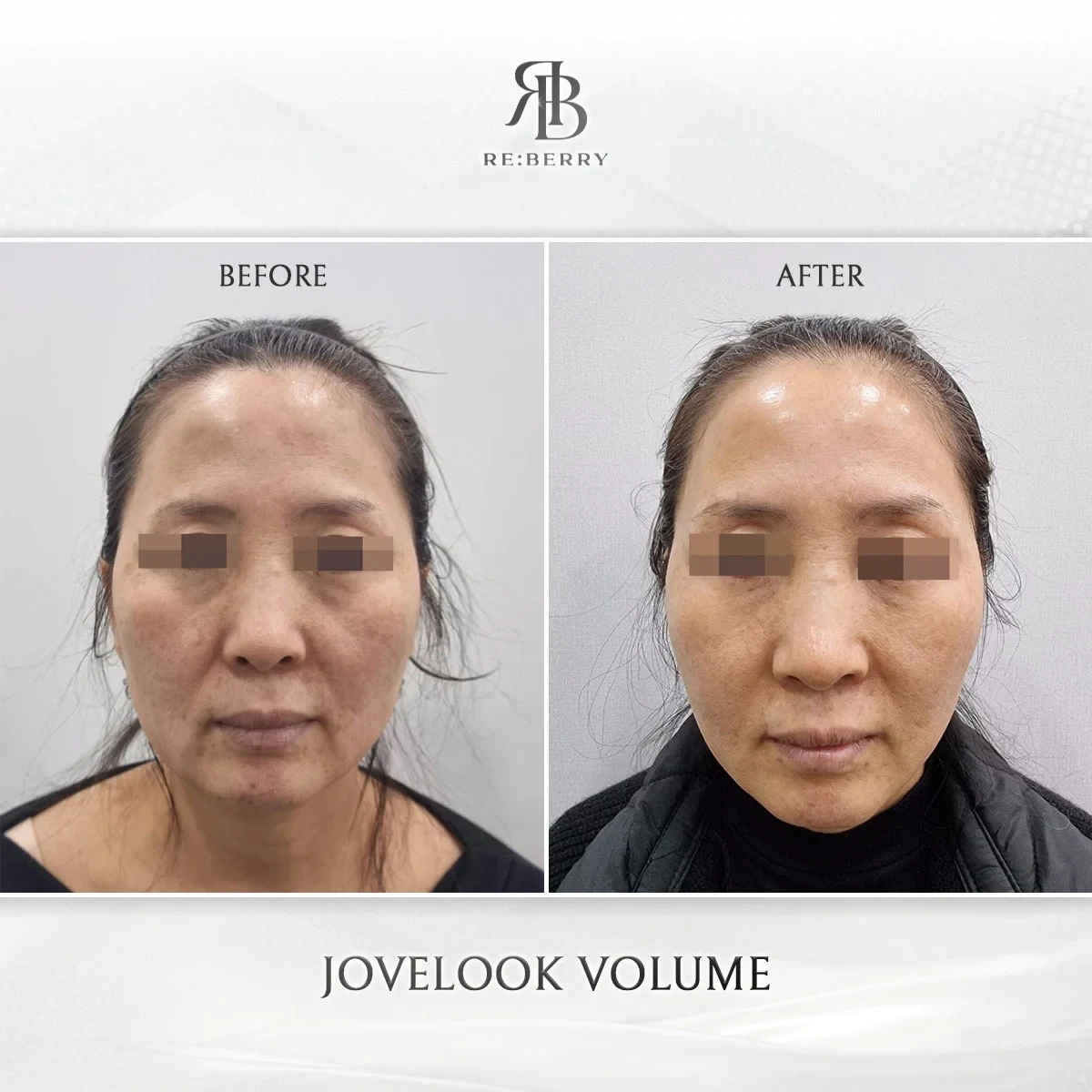 Before and after volume & filler treatment result at RE:BERRY Gangnam Aesthetic Clinic Seoul — real patient photo