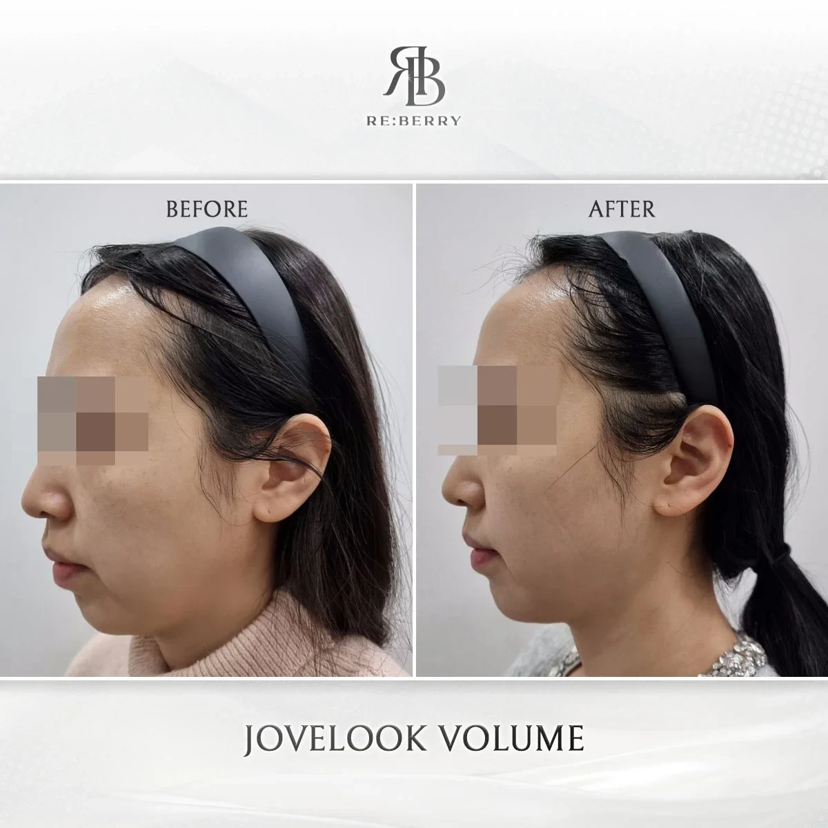 Before and after volume & filler treatment result at RE:BERRY Gangnam Aesthetic Clinic Seoul — real patient photo