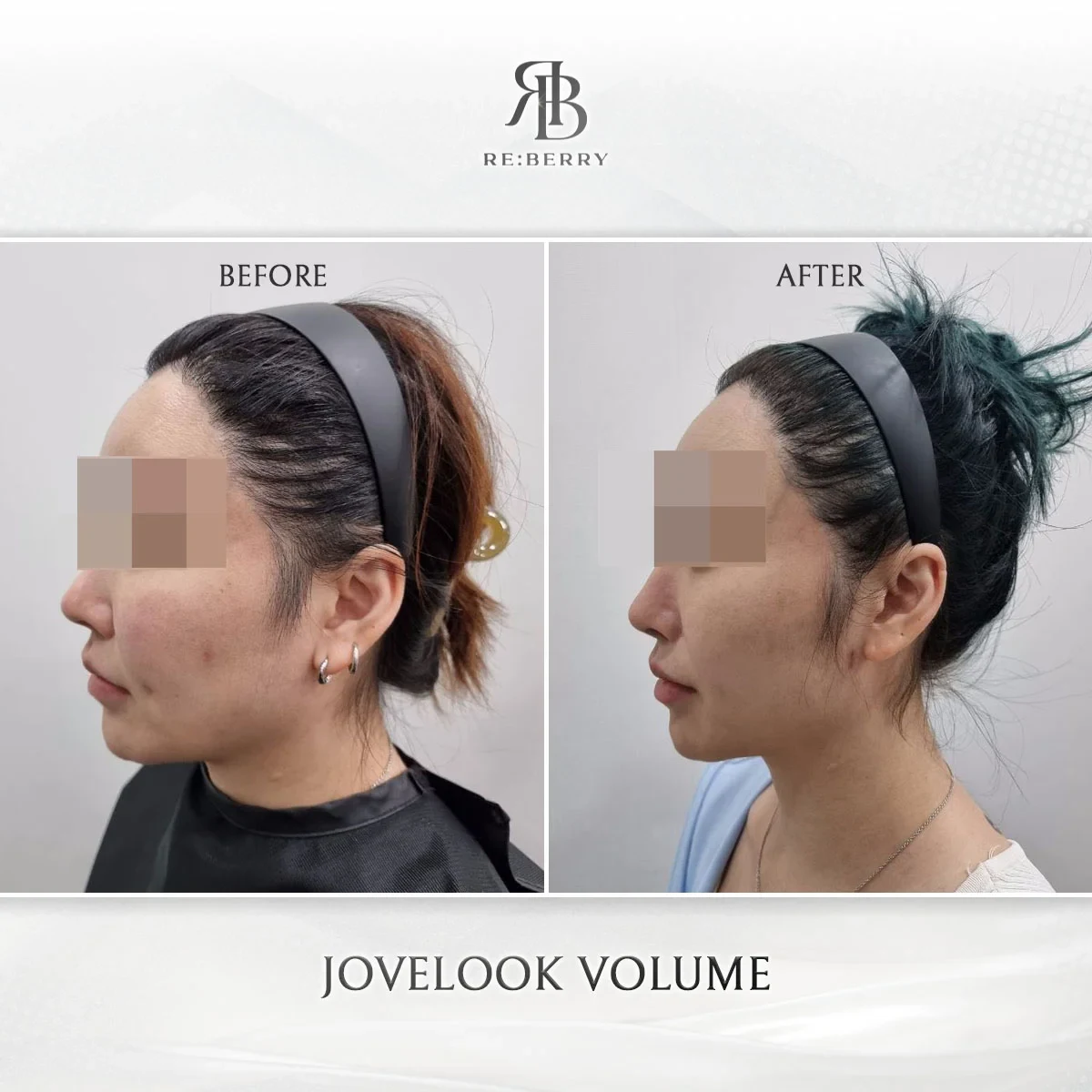 Before and after volume & filler treatment result at RE:BERRY Gangnam Aesthetic Clinic Seoul — real patient photo