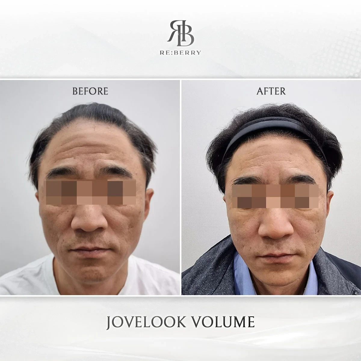 Before and after volume & filler treatment result at RE:BERRY Gangnam Aesthetic Clinic Seoul — real patient photo