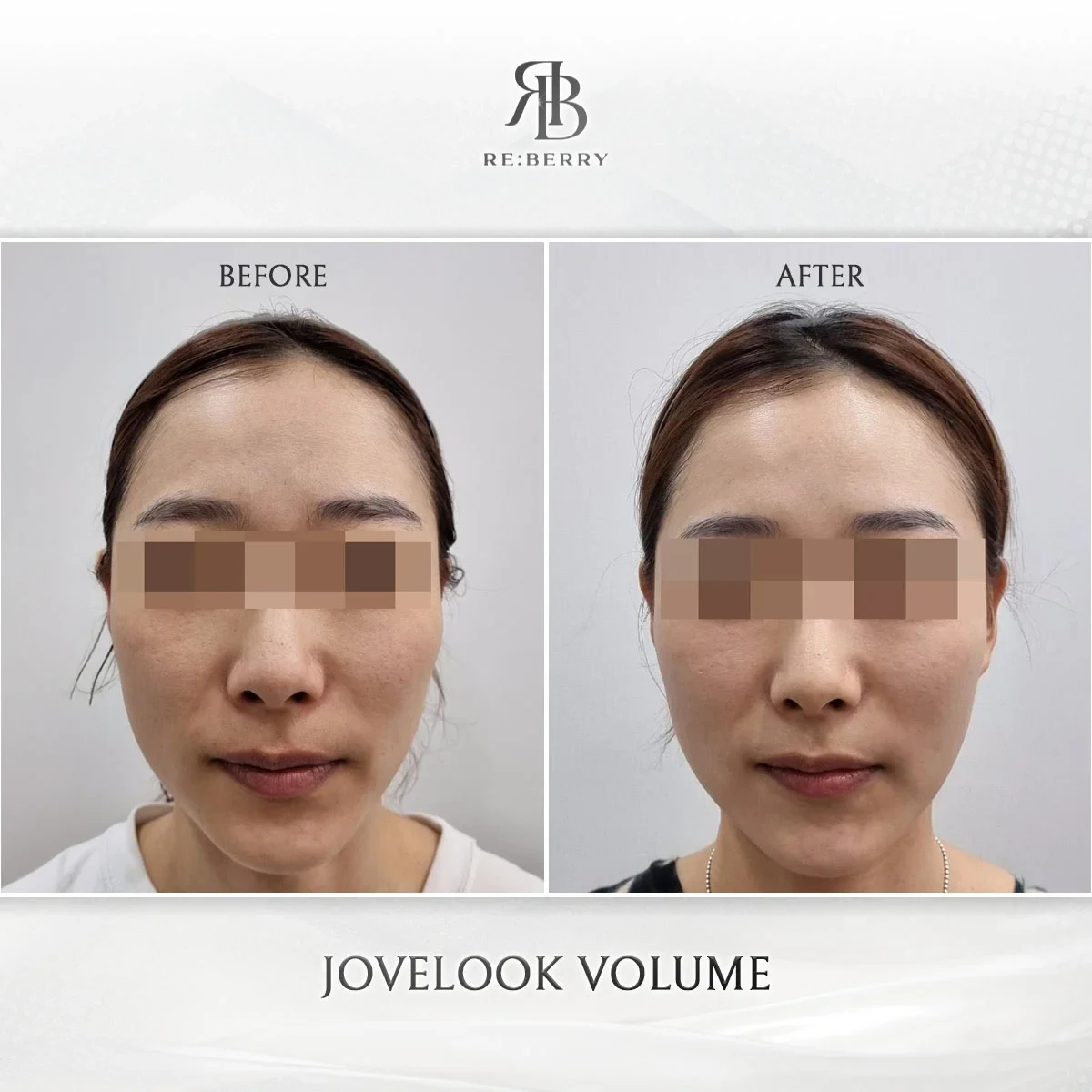 Before and after volume & filler treatment result at RE:BERRY Gangnam Aesthetic Clinic Seoul — real patient photo