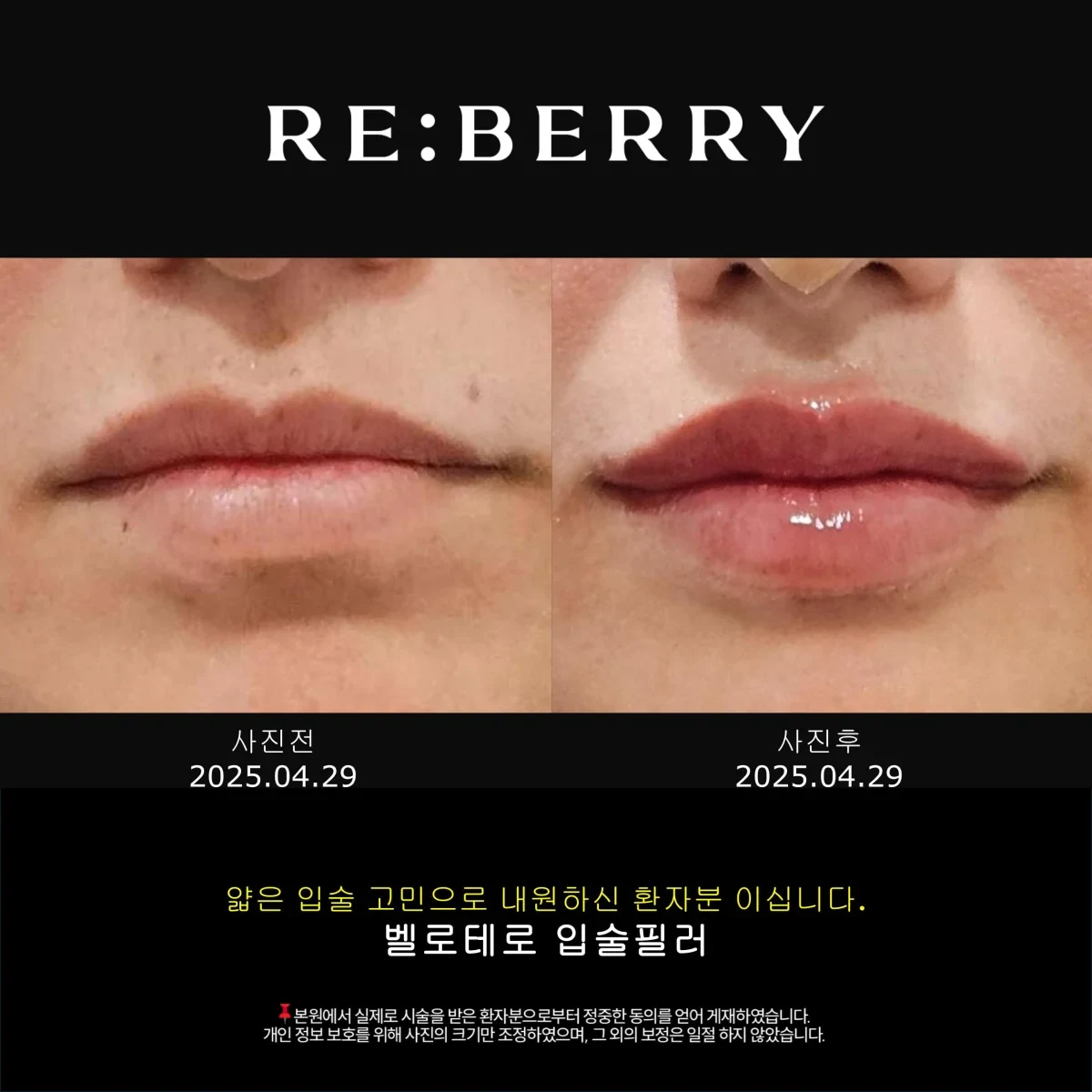 Before and after volume & filler treatment result at RE:BERRY Gangnam Aesthetic Clinic Seoul — real patient photo