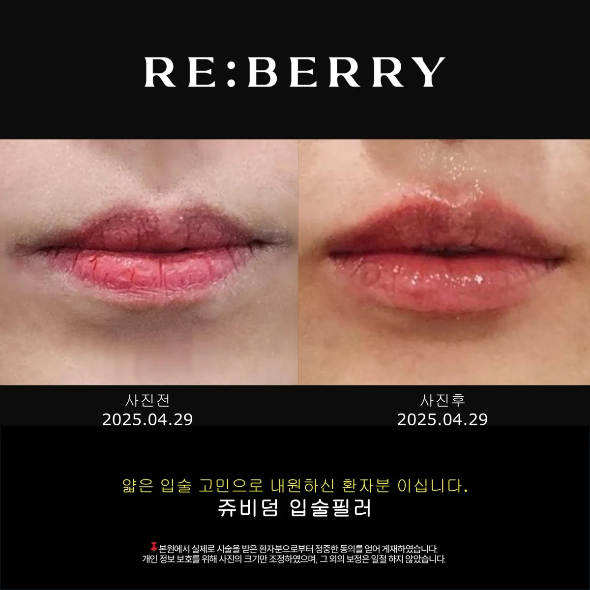 Before and after volume & filler treatment result at RE:BERRY Gangnam Aesthetic Clinic Seoul — real patient photo