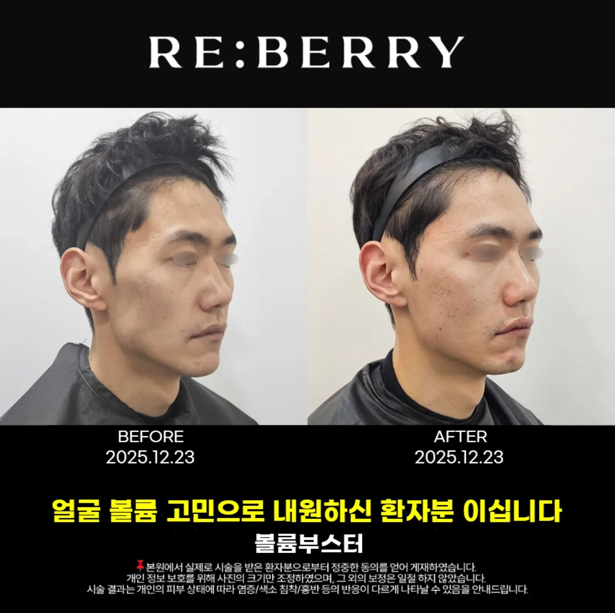 Before and after volume & filler treatment result at RE:BERRY Gangnam Aesthetic Clinic Seoul — real patient photo
