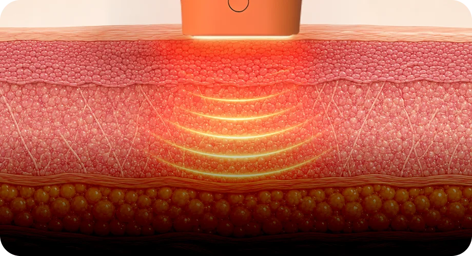 Broad Deep-Dermal Tightening