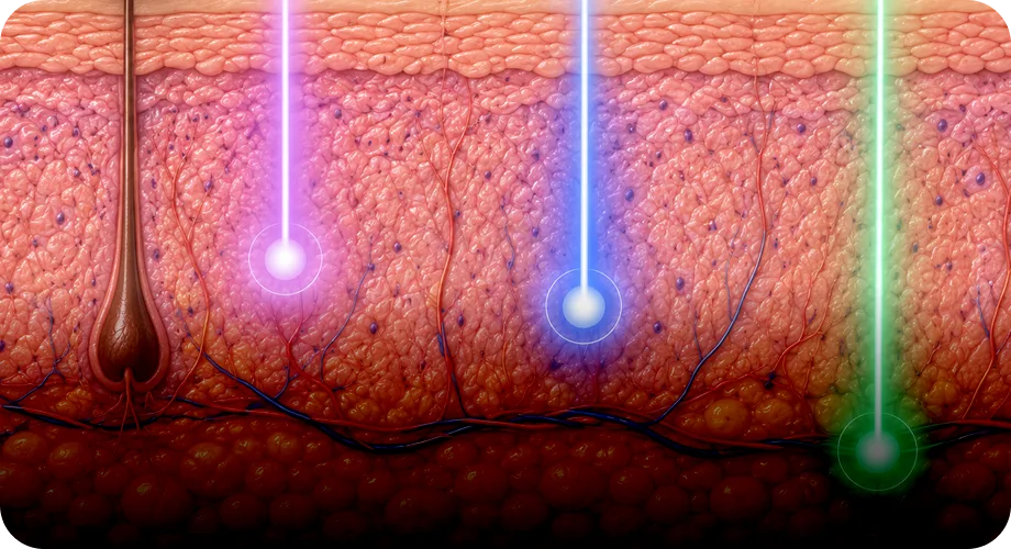 Broad Gradual Skin Warming